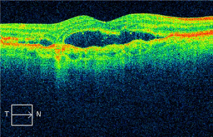 Goodwood Eye Centre Macular Degeneration01