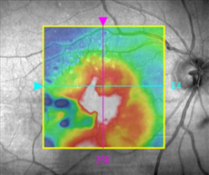 Goodwood Eye Centre Macular Degeneration02